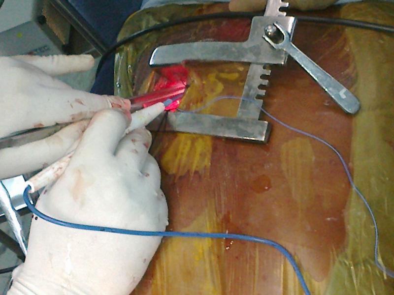 Dr Avinash Dal's incision for minimal access. only 5cm max