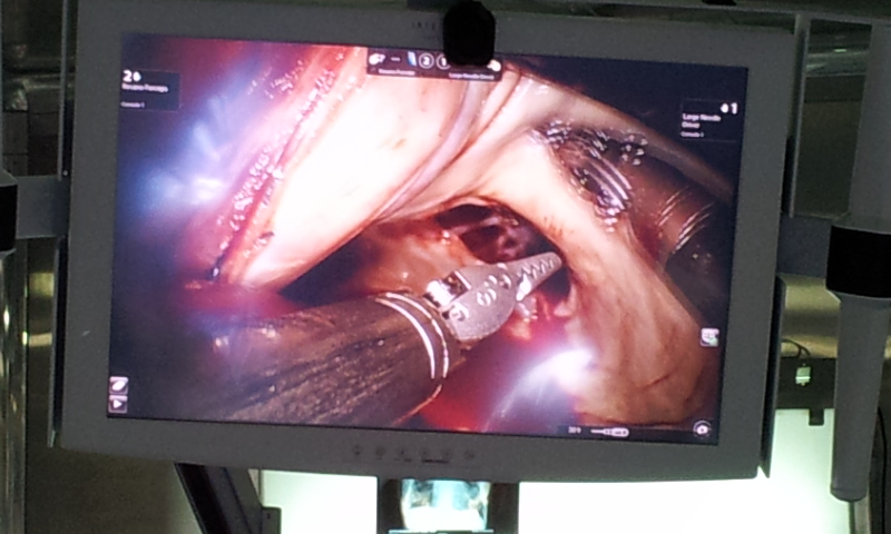 robotic mitral valve replacement  Dr Avinash Dal