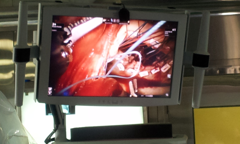 robotic mvr Dr Avinash Dal