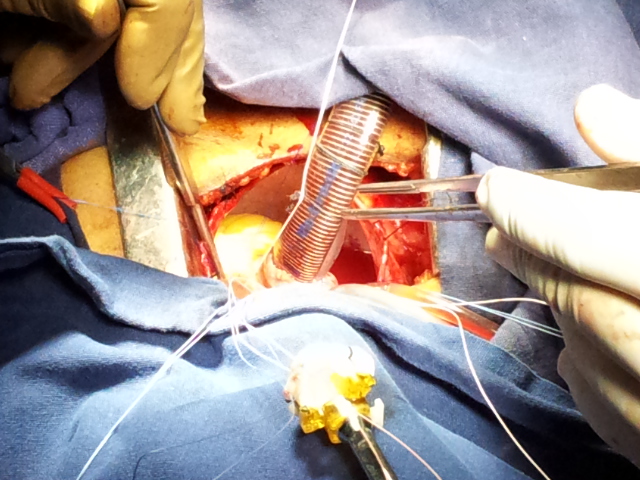 implanting aortic valve through the minimal access