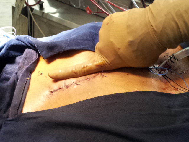Aortic valve replacement Ministernotomy Dr Avinash Dal