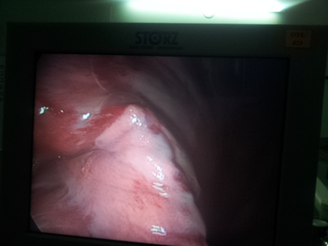 bulla of lung