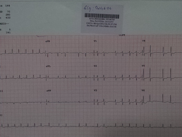 ecg before ablation of atrial fibrillation