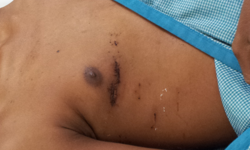 Minimal access Mitral valve incision by Dr Avinash Dal