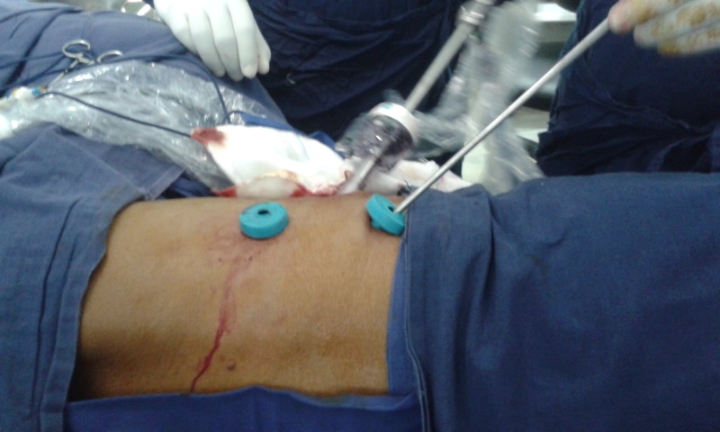 Dr Avinash Dal unit VATS Thoracoscopy, Apollo Hospital Hyderabad