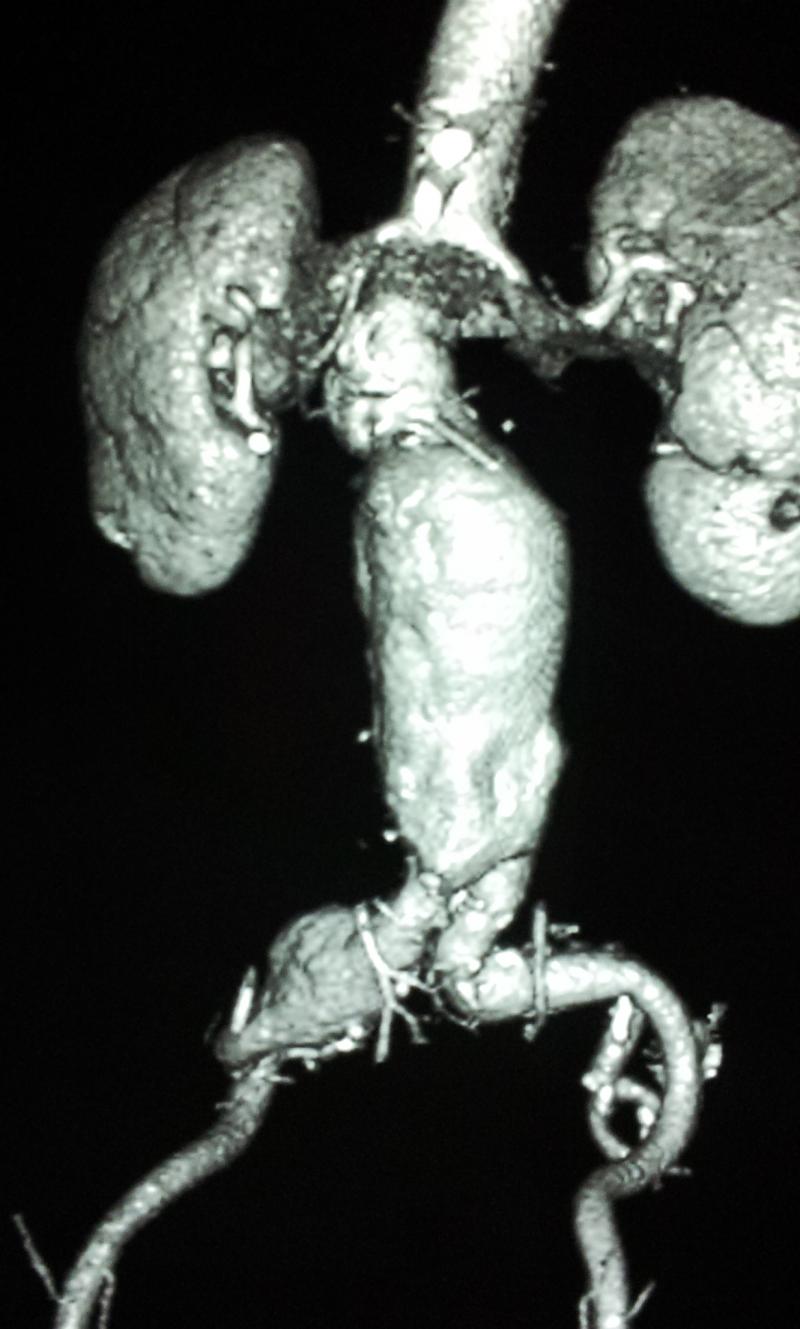 Abdominal aortic aneurysm