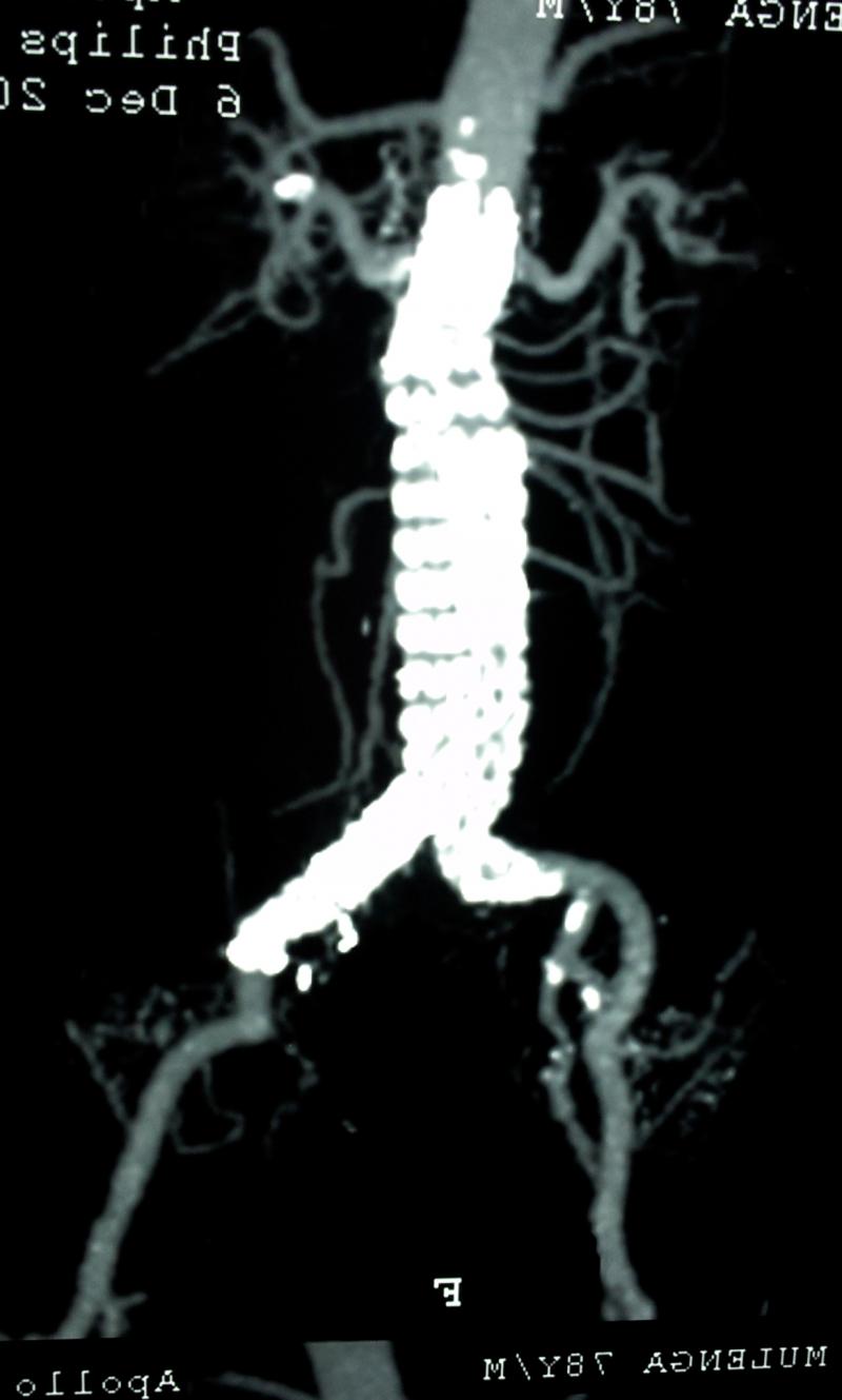 AAA repair endovascular