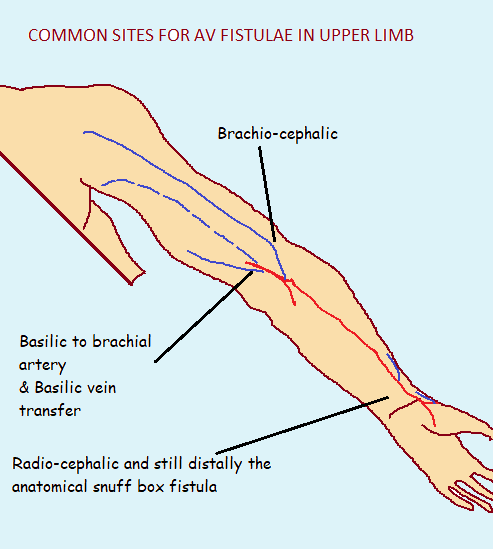 Common AV fistula in upper limb (bestcardiacsurgery.com)