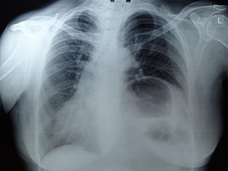 Xray of Eventration of diaphragm
