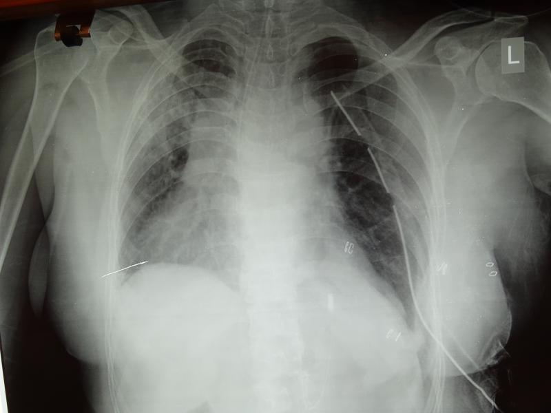 Eventration Diaphragm VATS repair of Dr Avinash Dal