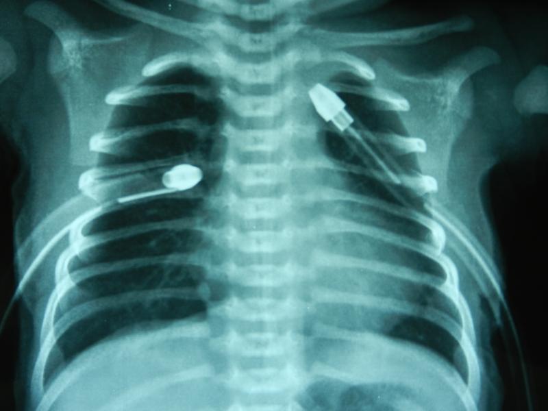 bilateral icd