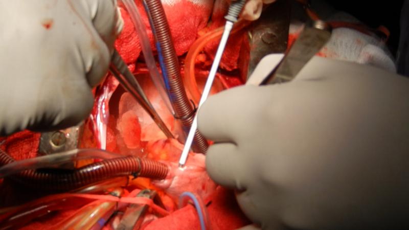 Medtronic cardioblate device being used for ablation by Dr Avinash Dal