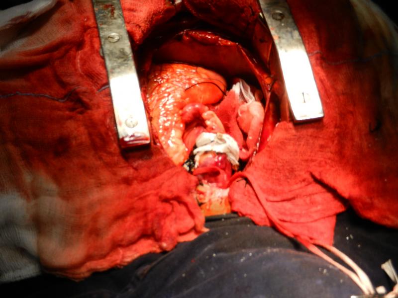 completed procedure including wrap by old aneurysm wall
