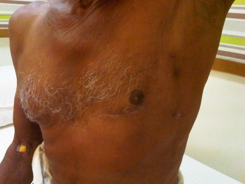 Dr Avinash Dal's patient with MICS [CABG]