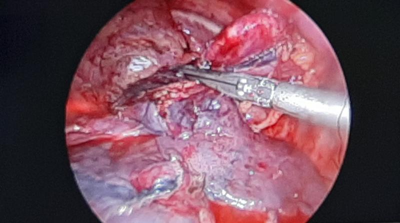 Dr Avinash Dal Right middle lobectomy subxiphoid VATS