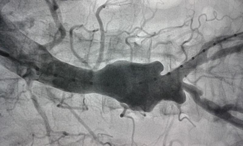 Dr Avinash Dal's EVAR (endovascular aortic repair)