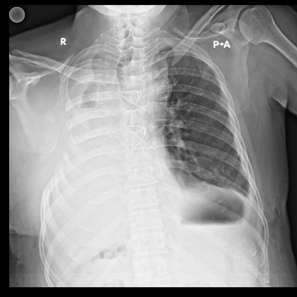 Dr Avinash Dal successful TSTP BPF closure  xray