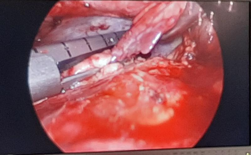 Dr Avinash Dal doing lingular resection via subxiphoid thoracoscopy VATS