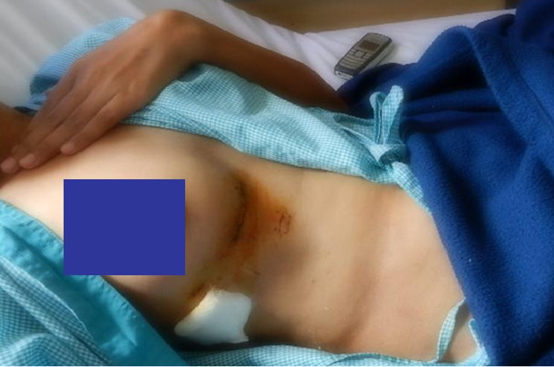 Minimal Access ASD through cosmetic incision (by Dr Avinash Dal)