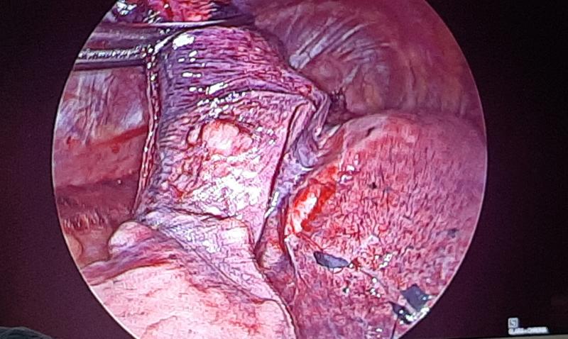 Dr Avinash Dal VATS staple line (endo-staplers lung thoracoscopic resection)