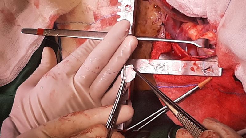 VSD patch closure Dr Avinash Dal bestcardiacsurgery.com