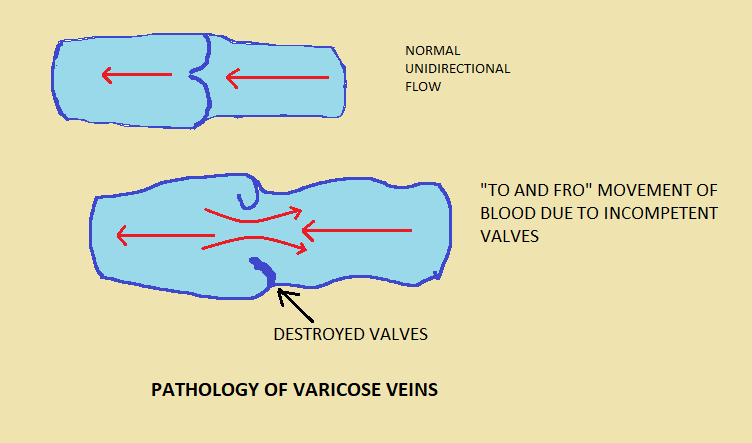 pathophysiology of varicose veins